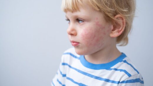 gluten-objawy-skorne